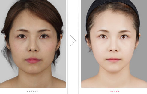 改脸型_改脸型手术_改脸型效果_改脸型方式有哪些
